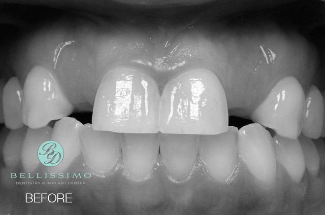 Smile Gallery | Bellissimo Dentistry & Implant Center | Chandler, AZ